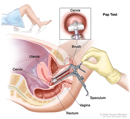 pap smear explanation diagram