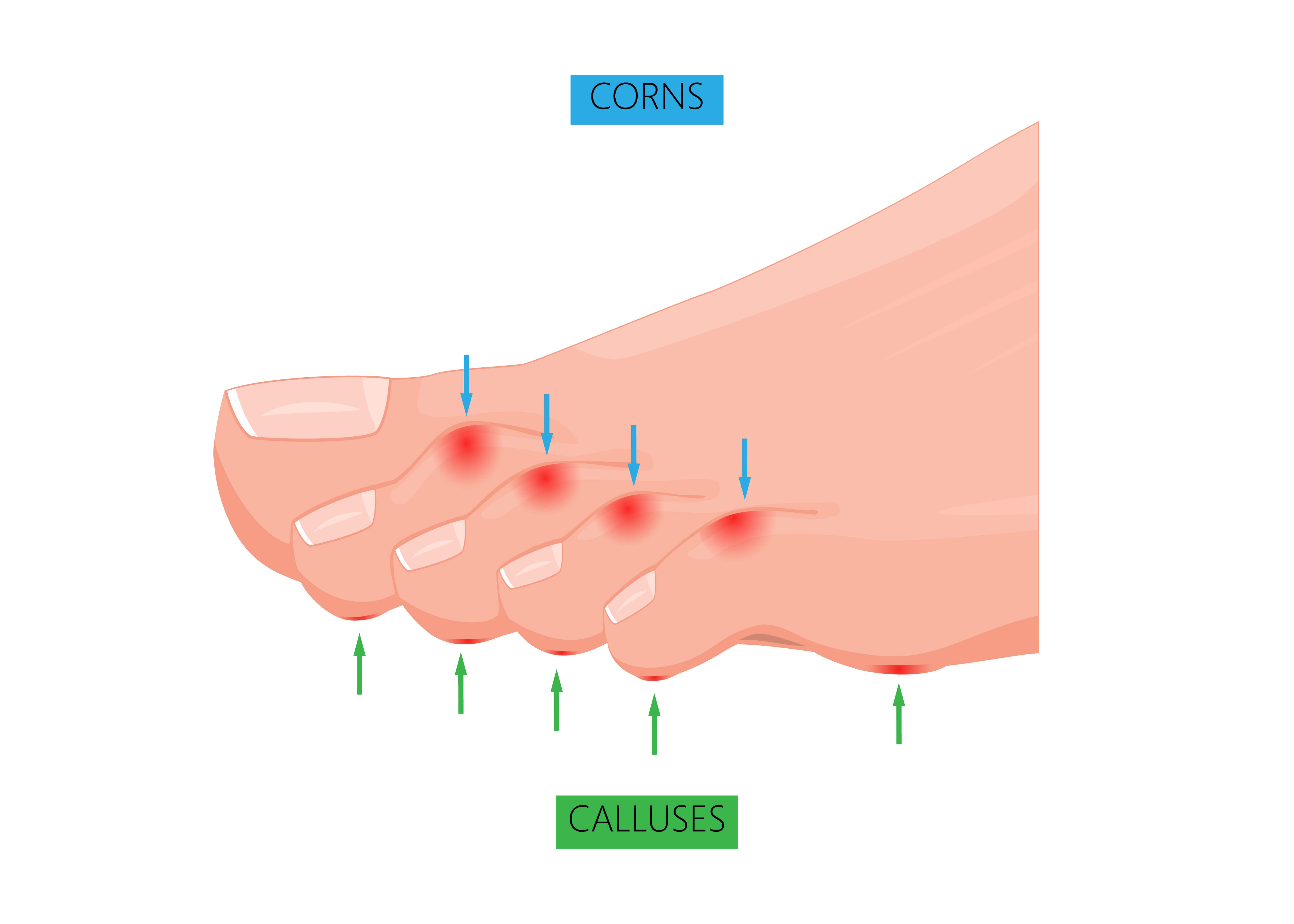 Corns and Calluses 1