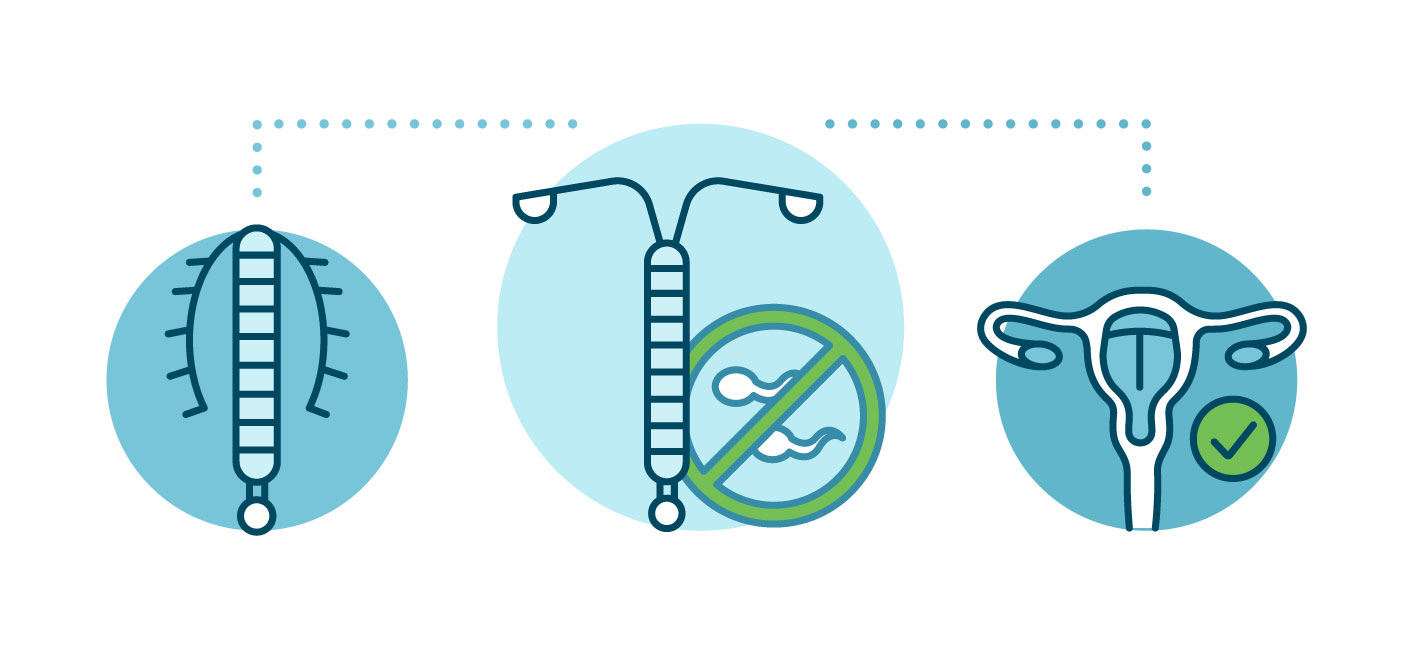 IUDs - Types of Contraceptives in Hong Kong